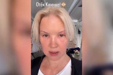 Экс-жена Серова показала, как выглядит ее лицо после отека Квинке: «Укусила пчела»